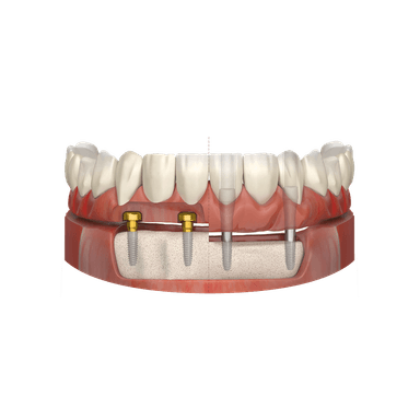 FIXEDSecure Implants