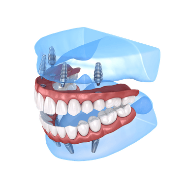 SnapSecure Implants