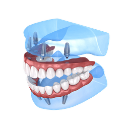 SnapSecure Implants